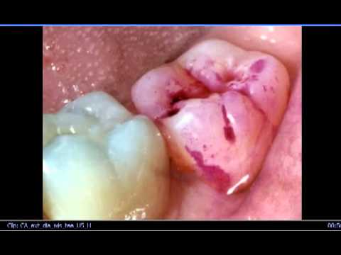 how to grow teeth faster