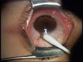 conjunctival brown tumor (spot) surgery by Isao Otaka M.D.