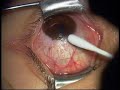 conjunctival brown tumor (spot) surgery by Isao Otaka M.D. conjunctival brown tumor (spot) surgery by Isao Otaka M.D.