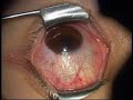 conjunctival brown tumor (spot) surgery by Isao Otaka M.D.