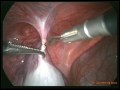 LAPAROSCOPIC ORQUIECTOMY