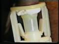 TaraKLamp Circumcision Device