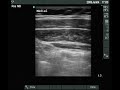 Ultrasound view of the abdominal wall