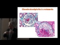 Click to View : Actualités thérapeutiques - Vascularites à ANCA - Pr.Guillevin - Mars 2016