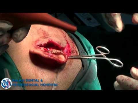 how to treat a zygomatic fracture