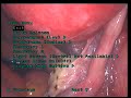 HYSTEROSCOPY