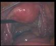 HYSTEROSCOPY