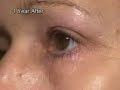 blepharoplasty laser technique  blefaroplastia utilizando la