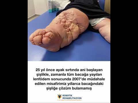 Robotik Rehabilitasyon Merkezi