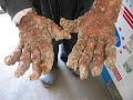 Extraña Enfermedad de la Piel - El Hombre Árbol