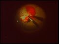 Retina Delaminacion