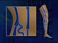 Treating Varicose Veins in Maryland with Dr. Michael Sulkin Treating Varicose Veins in Maryland with Dr. Michael Sulkin