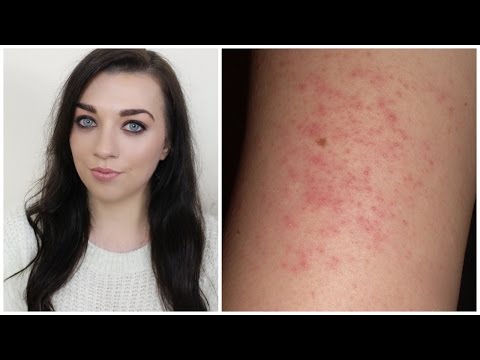 how to remove kp bumps
