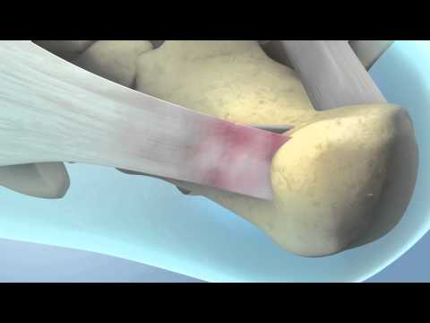 how to eliminate bone spurs