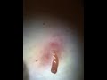 Cyst Part 2.9