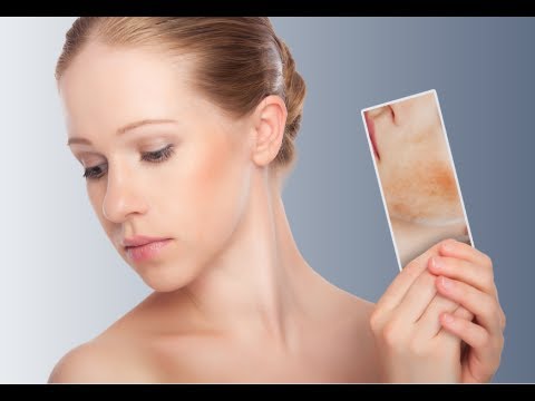 how to get rid of eczema on face quickly