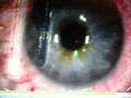 GETTING LASIK EYE SURGERY2
