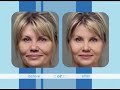Restylane for Creases - Endermologie Cellulite Reduction - Blue Medi Spa featured on Styles Spotlight Infomercial Part 3 of 3