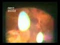 Retinal Videos on Slit Lamp + Mainster Lens SudhalkarEyeHosp