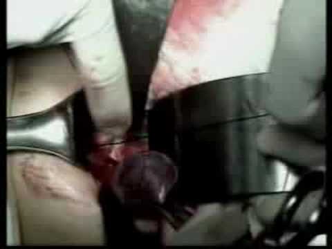 post op after laprascopic inguinal surgey