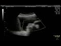 Zachary 30 weeks part1