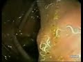 Parasites In Human Stomach