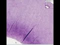 Histopathology Lymph node --Diffuse large B-cell lymphoma