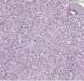 Histopathology Lymph node --Diffuse large B-cell lymphoma
