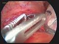 Lap gastric banding and repair of hiatus hernia Lap gastric banding and repair of hiatus hernia