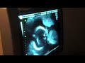 Ultrasound Anatomy Scan - 19 Weeks