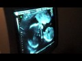 Ultrasound Anatomy Scan - 19 Weeks