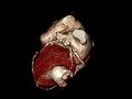 Aneurisma post-ischemico del ventricolo sinistro