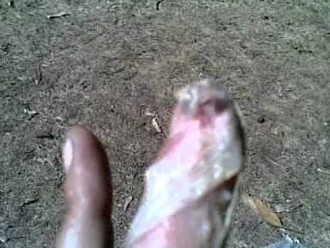 how to treat avulsion