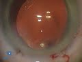 Scleral Tunnel Haemorrhage Phaco 3.1 Complications