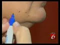 Smart Liposuction Orlando Florida - SmartLipo - Dr. Bassin