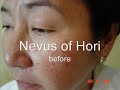 Lase removal for freckles and sunspots  Philippines and Asia.wmv