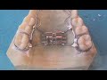 aparatos para la disyunci�n del maxilar superior desde lco�.