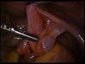 EMBARAZO ECTOPICO LAPAROSCOPICO 3 EMBARAZO ECTOPICO LAPAROSCOPICO 3