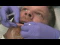 CO2 for actinic chelitis