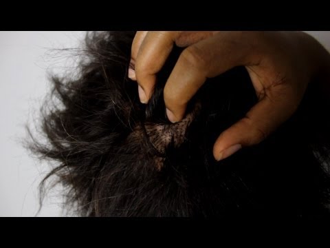 how to relieve psoriasis itching on scalp