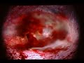 Blitz: The League II Injury (Ruptured Spleen)