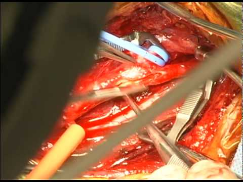 how to unclog arteries surgery