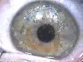 The LASIK Flap NEVER heals! The LASIK Flap NEVER heals!