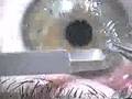 The LASIK Flap NEVER heals! The LASIK Flap NEVER heals!