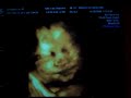 Baby 4D Ultrasound Video Baby 4D Ultrasound Video