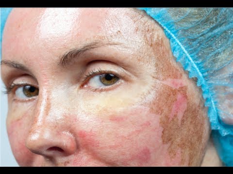 how to treat rosacea