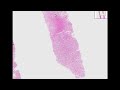 Histopathology Liver--Herpes hepatitis