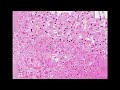 Histopathology Liver--Herpes hepatitis