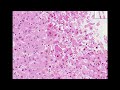 Histopathology Liver--Herpes hepatitis