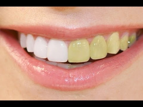 how to whiten teeth in pse 7